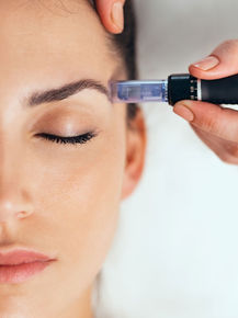 Beautiful dark-haired woman undergoing microneedling treatment at Nakd Aesthetics Medspa in Phoenixville, PA.