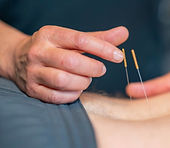 THERAPIST APPLYING ACUPUNCTURE TO HELPW WITH LOWER BACK PAIN