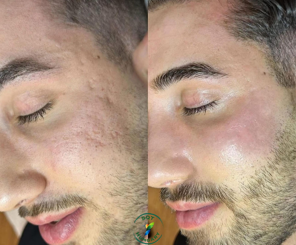Before and after SQT bio microneedling treatment for acne scars and uneven texture