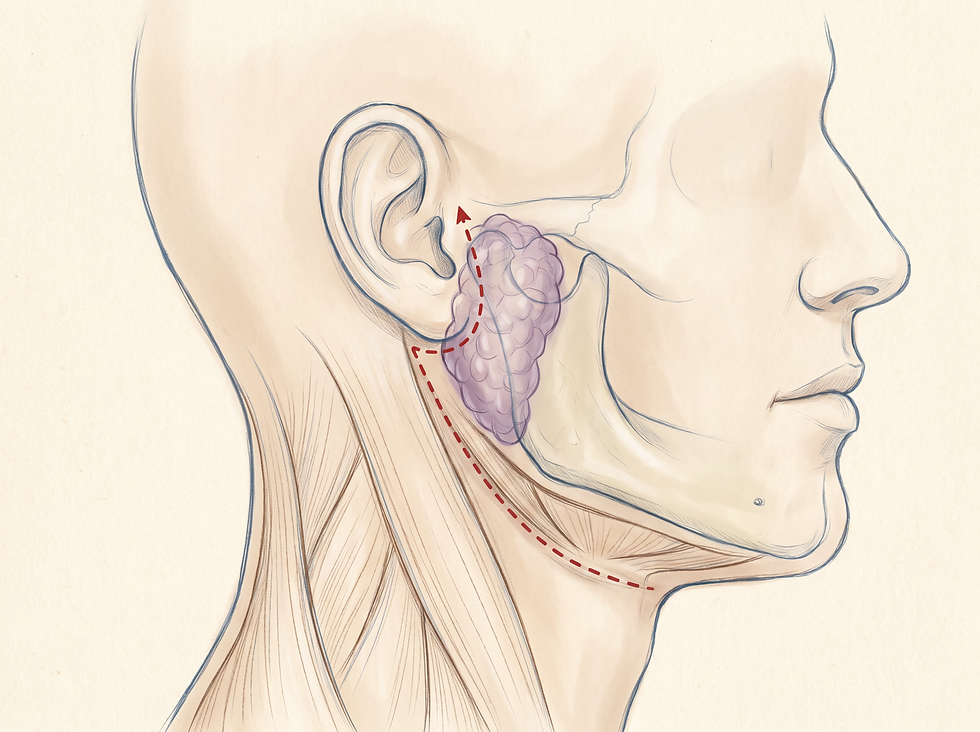 A professional medical illustration showing the location of the parotid gland in front of the ear and the surgical incision path used for tumor removal.