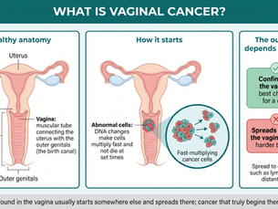 Infographic explaining vaginal cancer: healthy anatomy of the uterus, cervix, and vagina, how DNA changes make abnormal cells multiply fast and not die at set times, and how the outcome depends on timing, with cancer confined to the vagina having the best chance for a cure and cancer that spreads beyond the vagina being much harder to treat