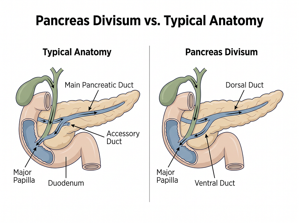 Infographic showing the anatomical difference between a typical pancreatic duct and pancreas divisum.