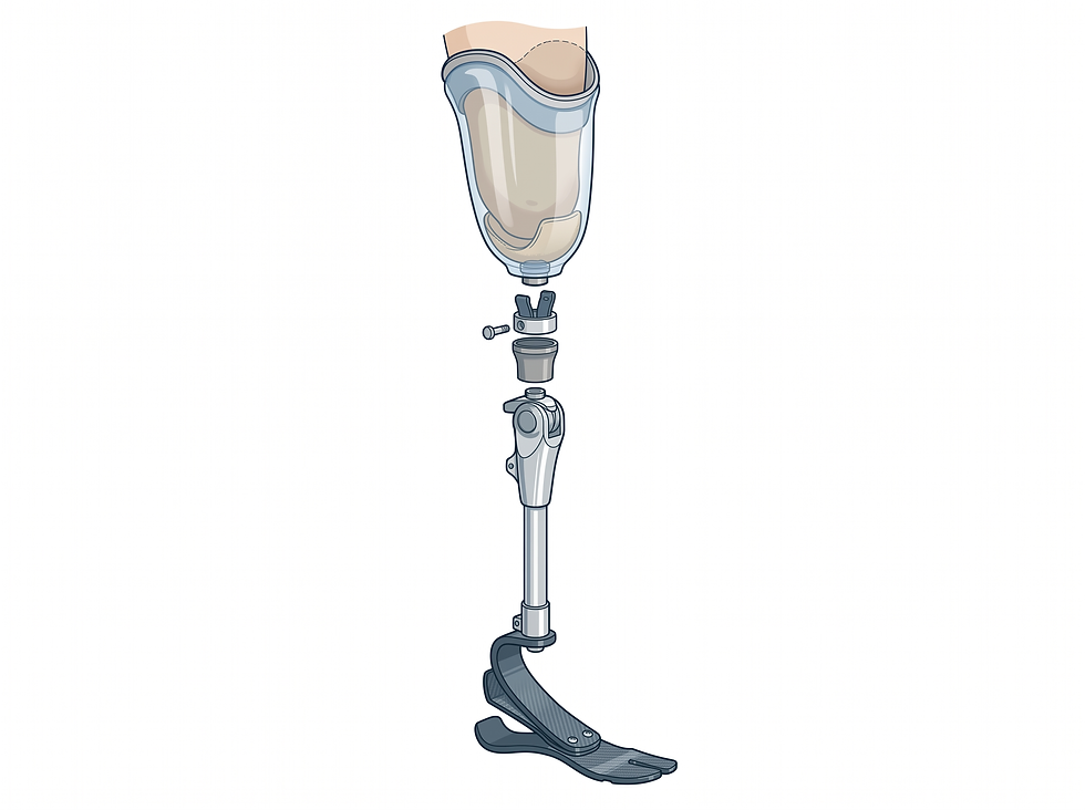 Exploded illustration of prosthetic leg components: custom socket, suspension system, metal pylon, and prosthetic foot