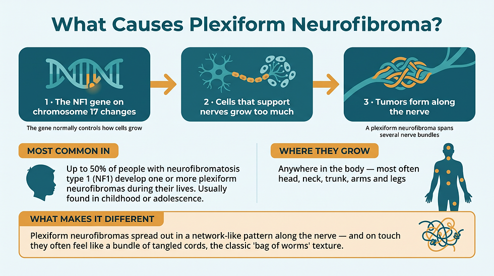 How plexiform neurofibroma develops — the NF1 gene link, where tumors grow, and what makes them different