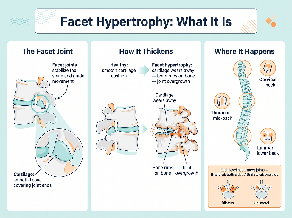 What facet hypertrophy is — the facet joint, how cartilage wear triggers bony overgrowth, and the cervical, thoracic and lumbar locations