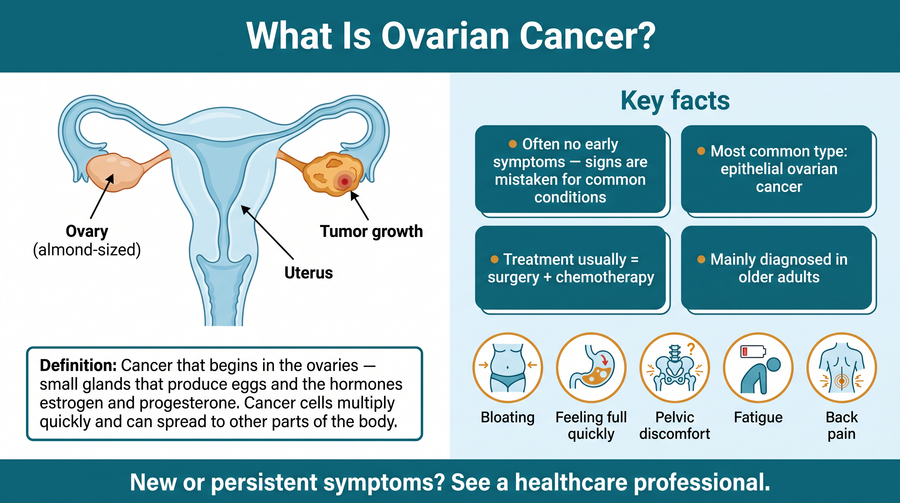 Ovarian cancer overview: a cancer that begins in the ovaries, the glands that produce eggs and the hormones estrogen and progesterone