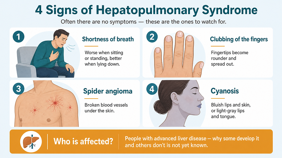 Infographic illustrating the four signs of hepatopulmonary syndrome: shortness of breath that is worse sitting or standing and better lying down, clubbing of the fingers, spider angioma, and cyanosis, with a note that the condition only affects people with advanced liver disease.