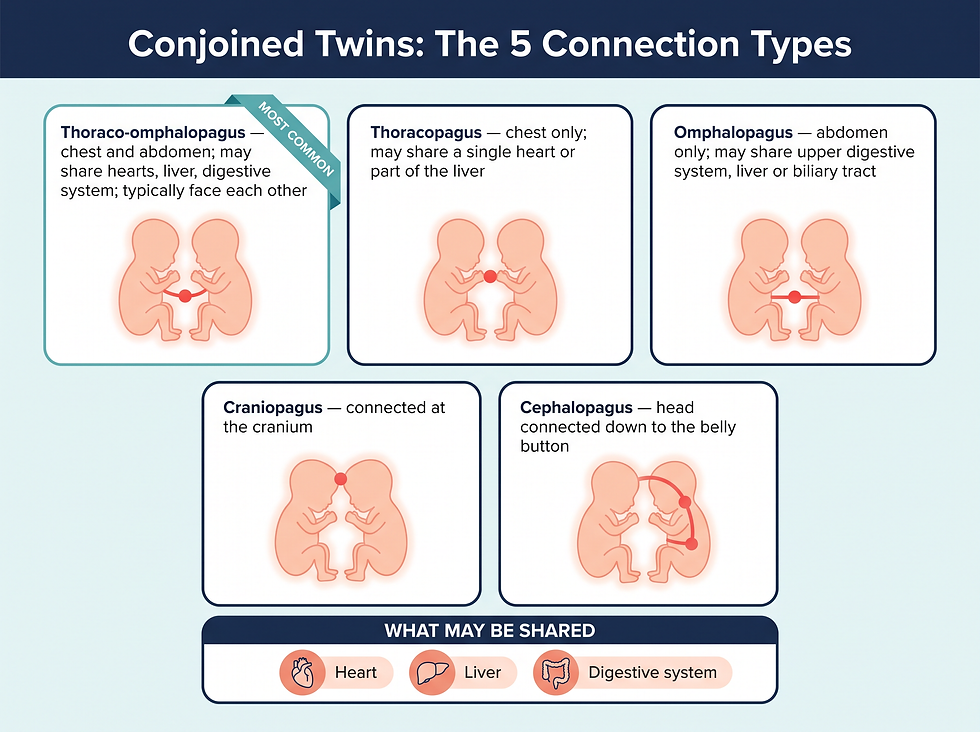 The 5 conjoined twin connection types: thoraco-omphalopagus, thoracopagus, omphalopagus, craniopagus, and cephalopagus, with organs that may be shared