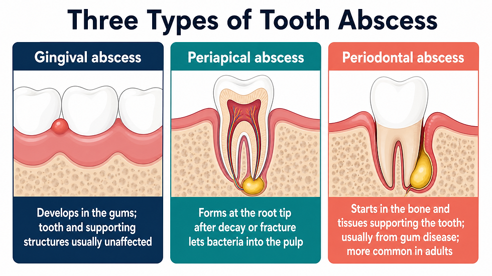 Comparison of the three types of tooth abscess: gingival, periapical, and periodontal
