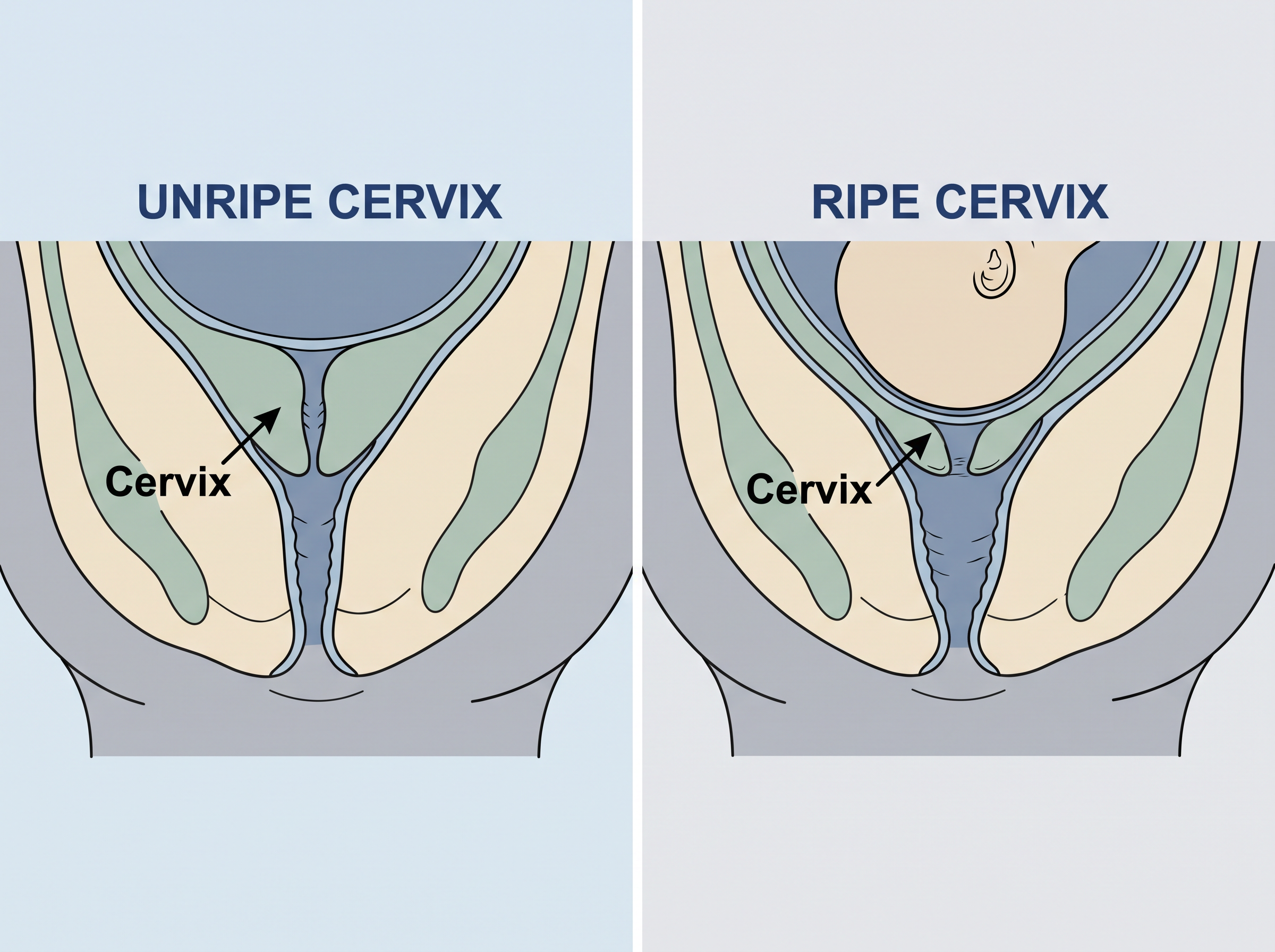 Cervical Ripening Process Overview