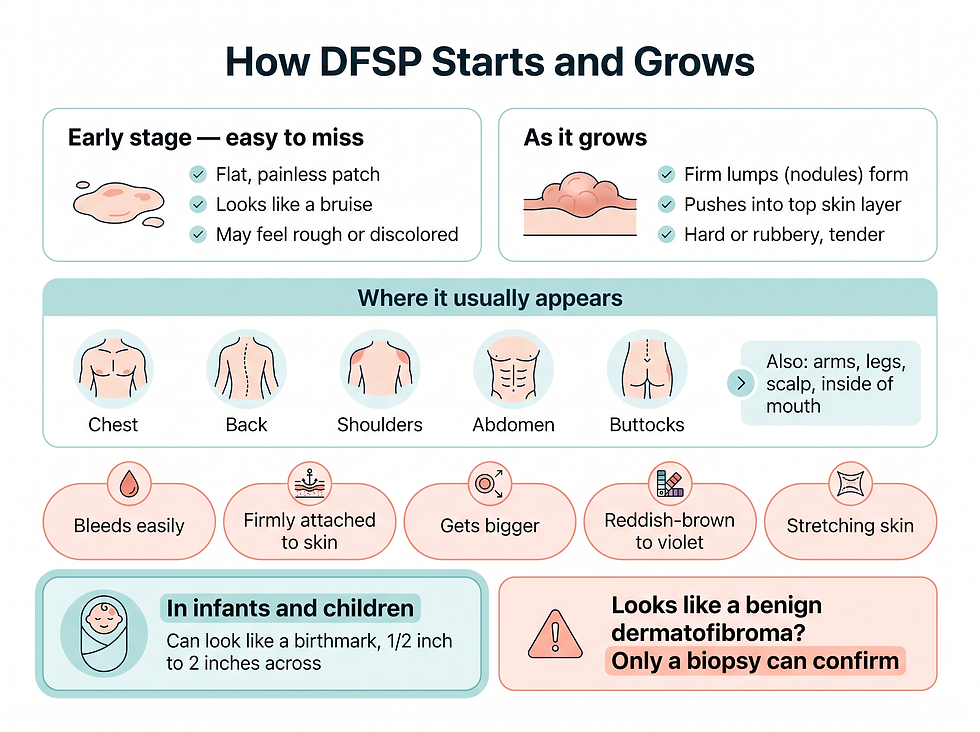 DFSP symptoms: from a flat, painless bruise-like patch to firm reddish-brown nodules, where it usually appears on the body, and why only a biopsy can confirm it