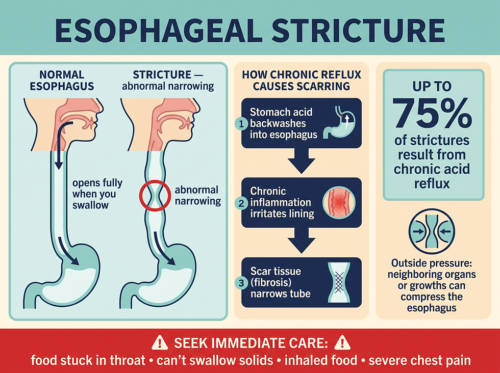 Esophageal stricture diagram showing normal vs narrowed esophagus and the acid-reflux scarring process