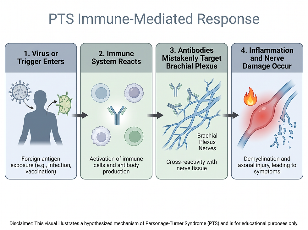 A medical infographic showing the hypothesized immune-mediated response that leads to brachial plexus damage in Parsonage-Turner syndrome.