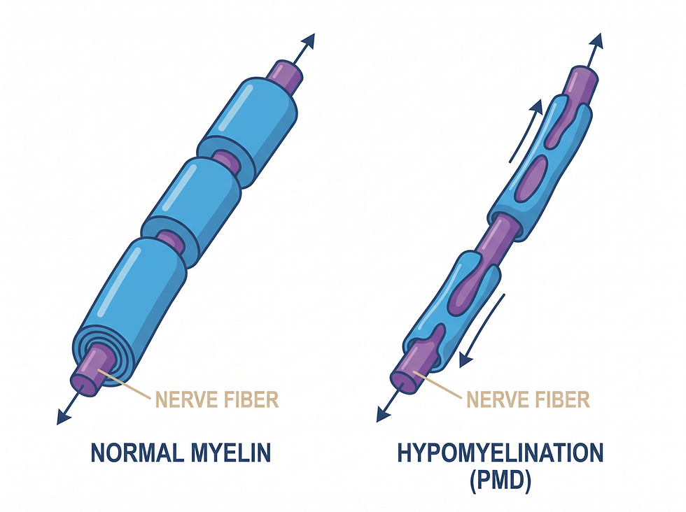Nerve fiber comparison showing normal myelin versus hypomyelination in Pelizaeus-Merzbacher disease