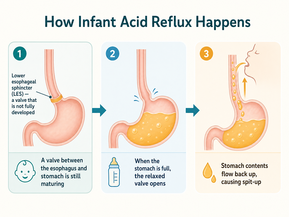 Diagram showing how infant acid reflux happens: a full baby stomach with an immature lower esophageal sphincter lets stomach contents flow back up into the esophagus