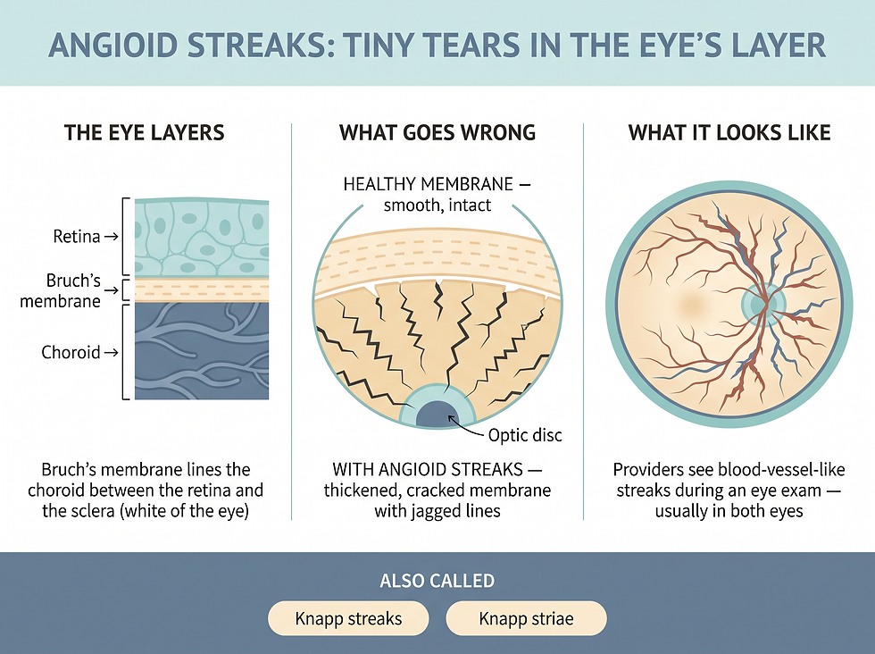 Diagram of the eye layers and how tears in Bruch's membrane create angioid streaks