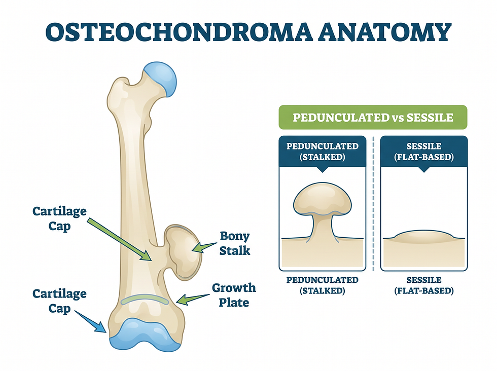 Osteochondroma anatomy showing the cartilage cap, bony stalk and growth plate, plus pedunculated versus sessile tumor types