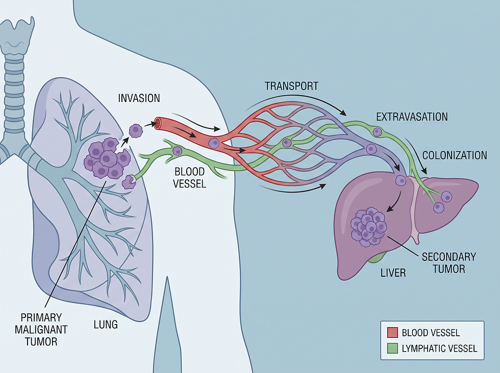 A medical diagram visualizing the process of metastasis, showing how malignant cells travel through the blood and lymphatic systems to establish secondary tumors in distant organs.