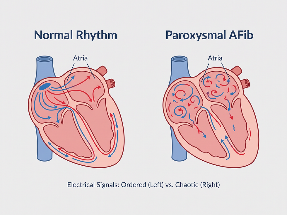 A professional medical diagram showing the difference between a normal heart rhythm and the chaotic electrical signals of paroxysmal atrial fibrillation in the upper chambers.