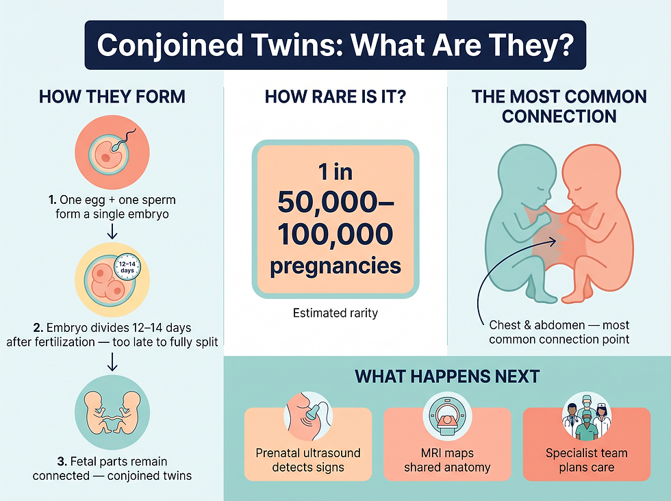 What conjoined twins are and how they form: a single embryo divides 12 to 14 days after fertilization, occurring in about 1 in 50,000 to 100,000 pregnancies