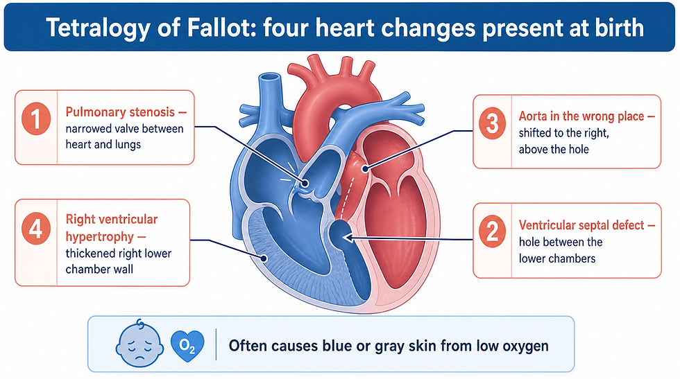 Cross-section illustration of a baby's heart showing the four structural changes of tetralogy of Fallot — narrowed pulmonary valve, hole between the lower chambers, aorta shifted to the right above the hole, and thickened right lower chamber wall — with a note that the condition often causes blue or gray skin from low oxygen.