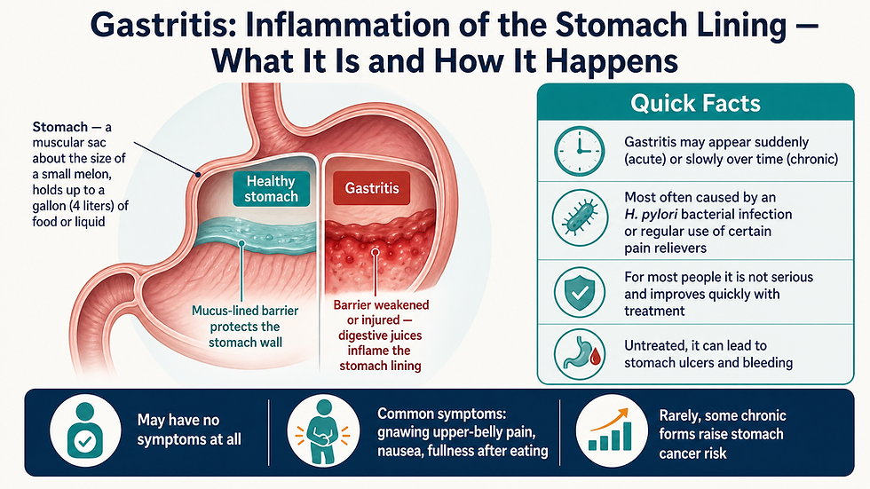 A healthy stomach is protected by a mucus-lined barrier. In gastritis, that barrier is weakened or injured, allowing digestive juices to inflame the stomach lining.