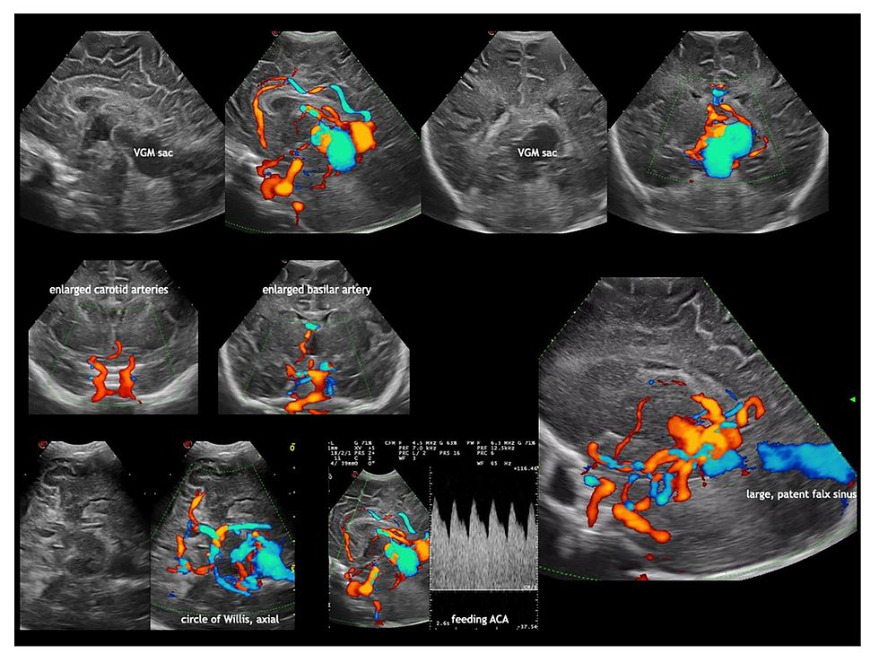 Hallazgos asociados al aneurisma de vena de Galeno en Doppler. Tomado de Horsch S. Dev Med Child Neurol 2024.