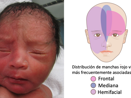 #18 Manchas rojo vino en el rostro del recién nacido ¿Qué riesgo representan?