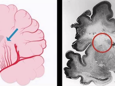 #201 Leucomalacia periventricular en América Latina ¿cómo vamos?