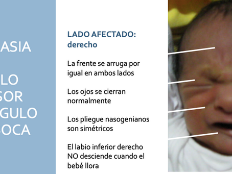 #56 El recién nacido con asimetría facial al llanto