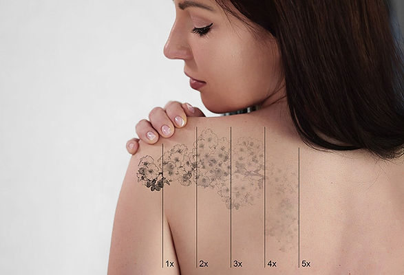 laser-tattoo-removal.jpg