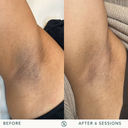 Laser hair removal before and after