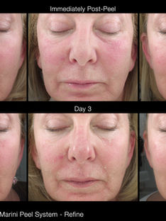 JanMariniTreatmentPhotosMariniPeelSystems_images_RefinePeel_1Progression_HD.jpg