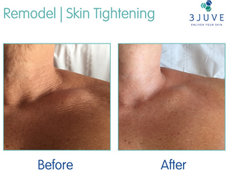 Sculpt, Lift and Tone your skin with Radio Frequency