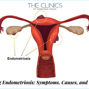 endometriosis