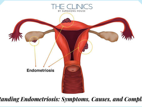 endometriosis