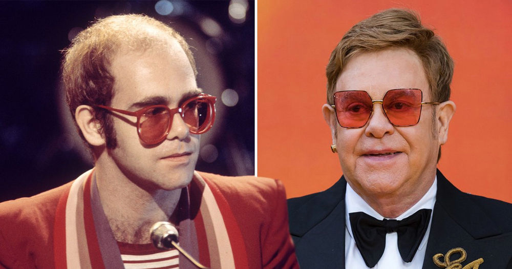 the-best-celebrity-hair-transplant-results