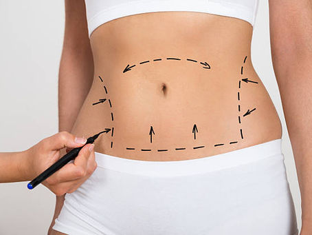 Steps to Take to Recover from Liposuction Surgery