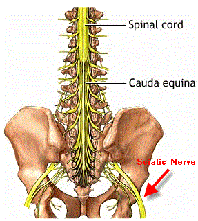 What is Sciatica?