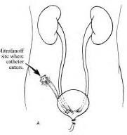 Mitrofanoff Procedure: "Game Changer”