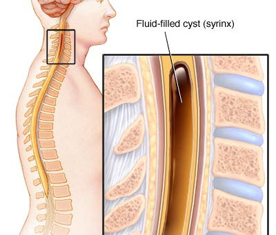 Syringomyelia…What’s that?