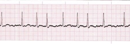 The Connection Between SCI, Surgery, and Heart Problems and Why Does it Matter?