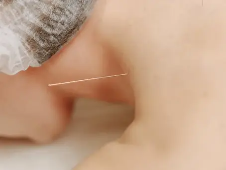 How Can Acupuncture Help with Pain Management?