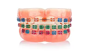 7 Signs Your Child Might Need Pediatric Orthodontics