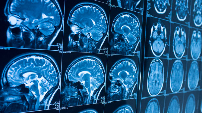 What is a Brain Tumor?