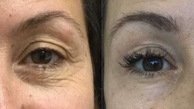 Making tired eyes sparkle and dance again doesn't need to involve surgery