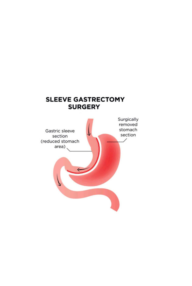 cwmw-sleeve-gastrectomy-700x400 copy.jpg