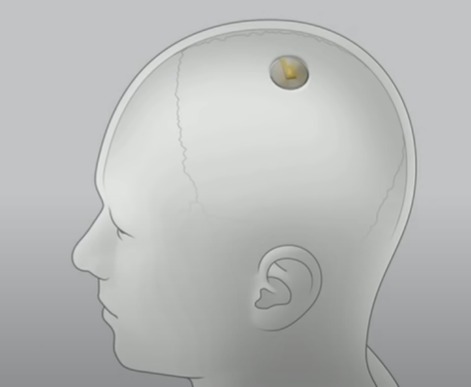Elon Musk's Neuralink Implant