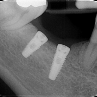 La componentistica implantare