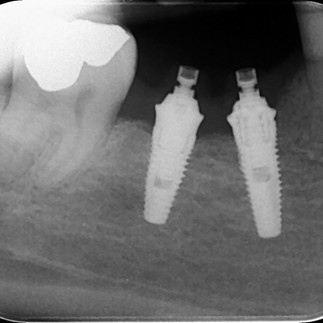 La componentistica implantare